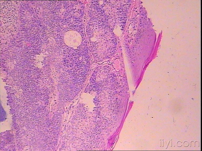 讨论:考虑增生性毛根鞘囊肿,需要鉴别外毛根鞘癌或皮脂腺癌,患者年龄