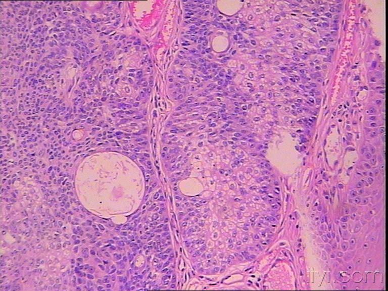 讨论:考虑增生性毛根鞘囊肿,需要鉴别外毛根鞘癌或皮脂腺癌,患者年龄