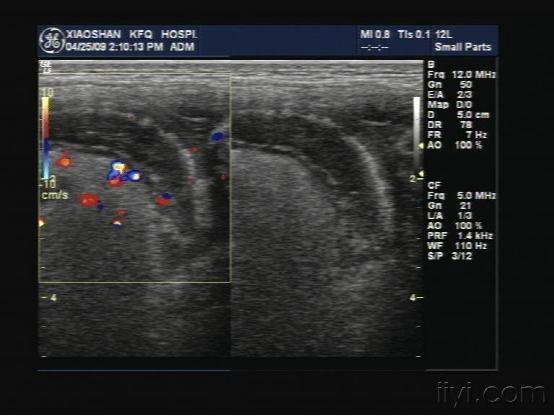 超声诊断阑尾炎经验