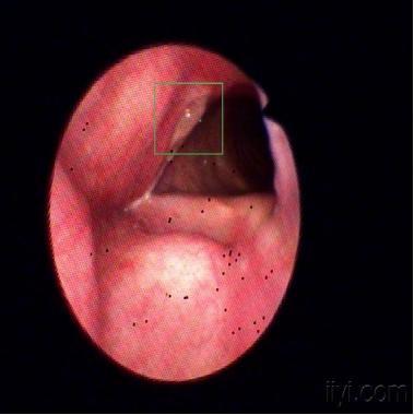 间接喉镜下见会厌无水肿,抬举欠佳,声门欠清,纤维喉镜:右侧喉室饱满