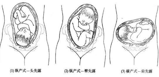 2011护士执业考试妇产科妊娠妇女胎产式胎先露胎方位的护理
