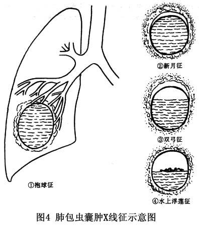 肺包虫病图