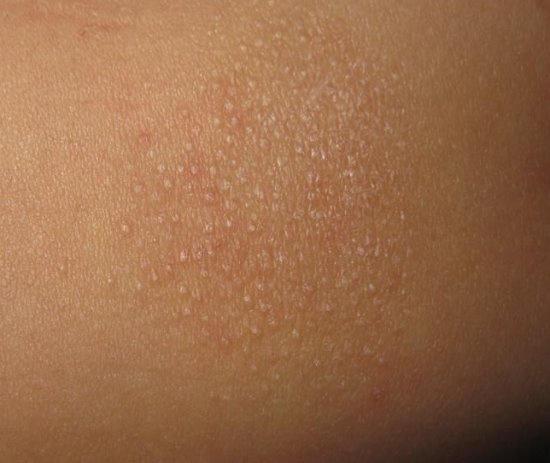 光泽苔藓图光泽苔藓是一种原因未明的慢性皮肤病,临床主要表现为帽