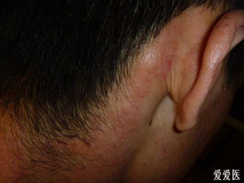 是以阵发性皮肤瘙痒和皮肤苔藓化为特征的慢性皮肤病.