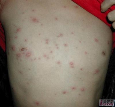 水痘图片水痘是由水痘带状疱疹病毒初次感染引起的急性传染病,主要