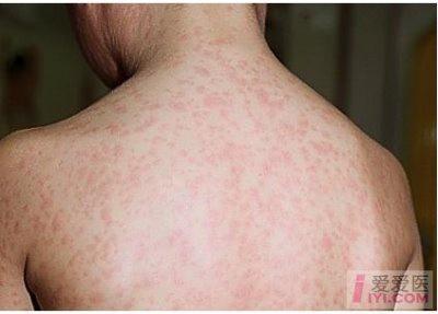 斑丘疹和颊粘膜上有麻疹粘膜斑及疹退后遗留色素沉着伴糠麸样脱屑为