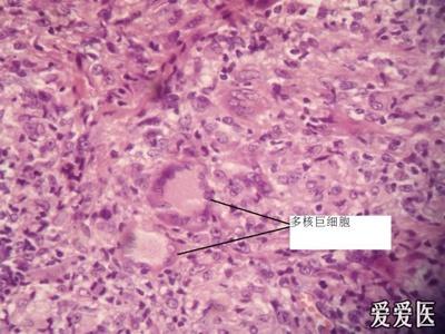 颜面播散性粟粒性狼疮