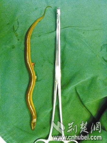 首页 医视角 > 与鱼共浴 男子遭黄鳝钻尿道进膀胱       "男性尿道口