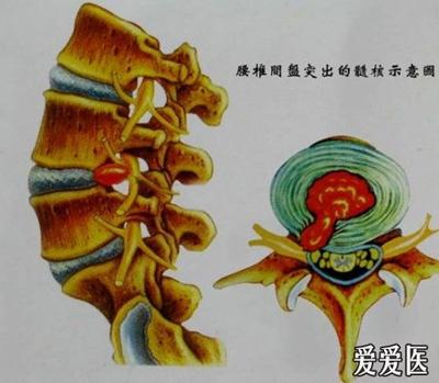 的基础上,产生椎间盘和相应椎间关节及其附属组织一系列的病理变化