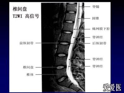 解剖和生理(2)      中央型椎间盘疝出物位于椎管中部主要对硬膜外
