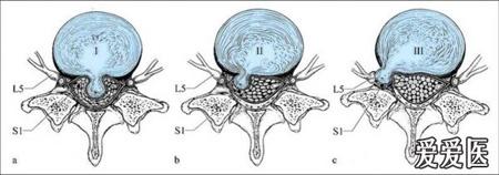 椎间盘突出(中央型)