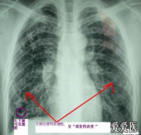 急性感染消失后也常留下小片状,小块状病变及纤维化,因此肺体积常缩小