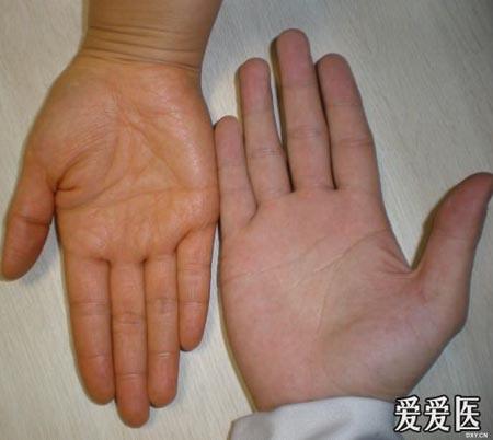 胡萝卜素血症