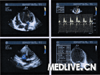 患者术前超声心动图,左室显着扩大