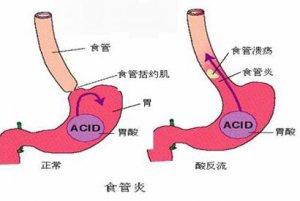奥美拉唑治疗反流性食管炎的效果