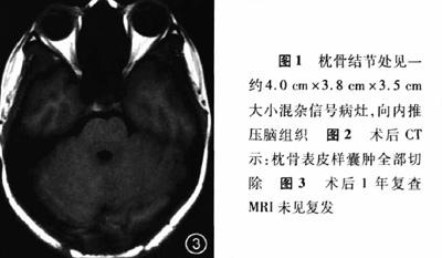 颅骨表皮样囊肿2例