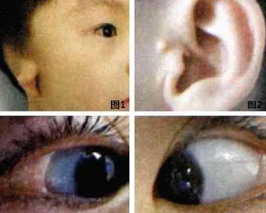 因"自出生即发现双眼外侧肿物"于2010年8月23日收入我科.