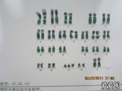 小儿21三体综合征