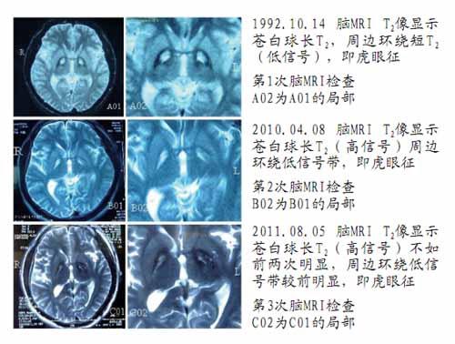 苍白球黑质色素变性