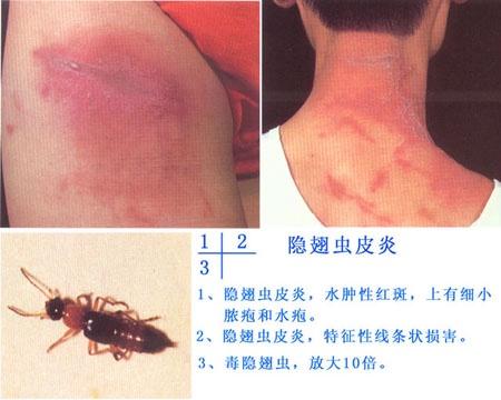 急性红斑疱疹性损害的皮肤病,隐翅虫皮炎在全世界的热带和亚热带地区