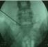 视频：颈腰椎间盘胶原化学溶解术