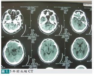 间断恶心,呕吐,乏力3月,垂体卒中