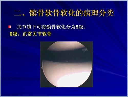 点击下载ppt课件:髌骨软化症的诊断及治疗