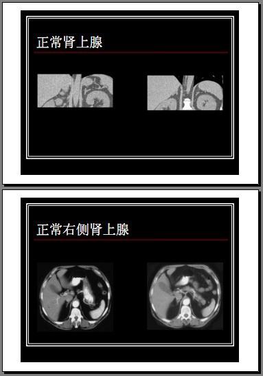 肾上腺疾病ct读片