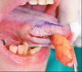 罕见舌脂肪瘤一例