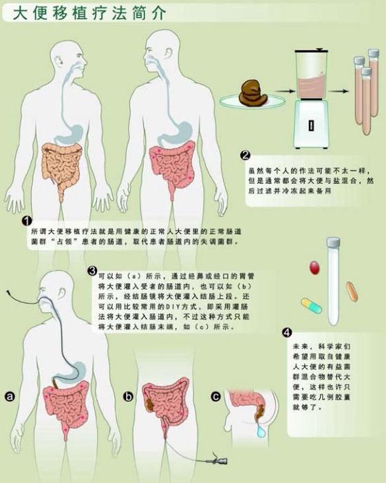 nieuwdorp认为大便移植疗法还有很多其它用途,不过这还需要时间去开发