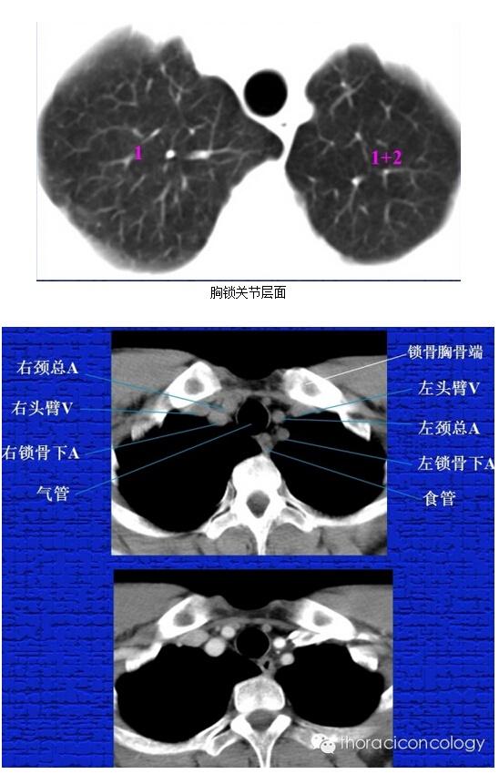 胸部正常ct解剖结构
