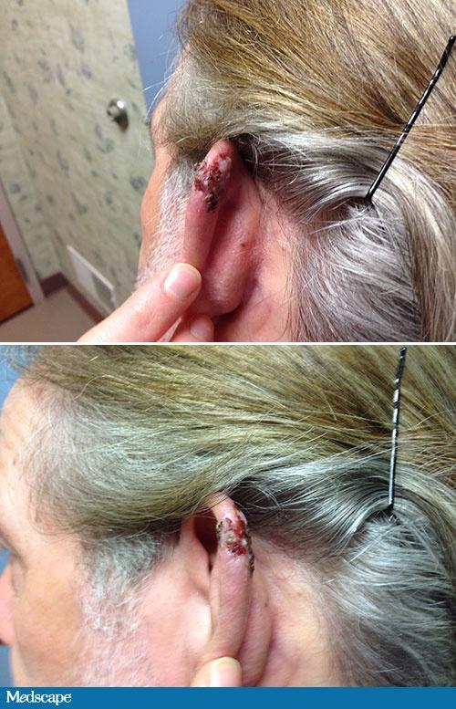耳廓赘生色素结节,如何诊断?