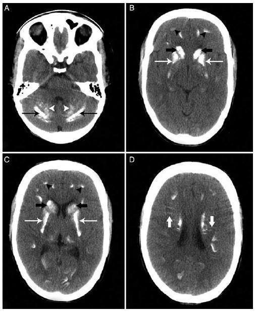 双侧基底节钙化如何诊断