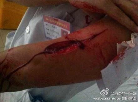 四川成都华阳石油医院外科医师被砍伤