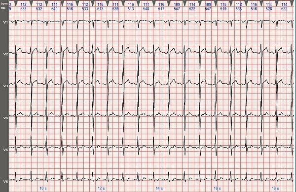心电图图例分析:i型心房扑动呈2:1房室传导