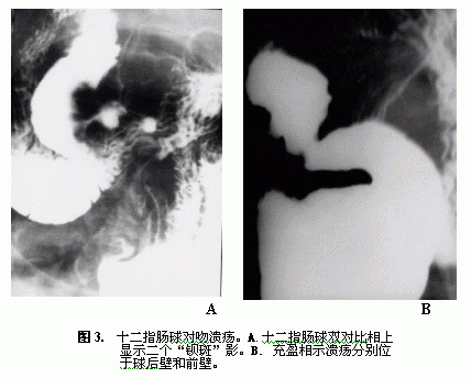 十二指肠溃疡的影像学诊断