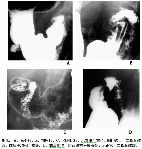 十二指肠溃疡钡剂造影图片