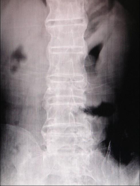 强直性脊柱炎早期图片