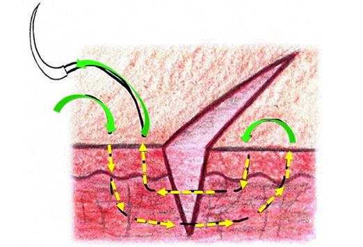 垂直褥式縫合水平褥式縫合subcuticular連續縫合連續縫合伸指肌腱縫合