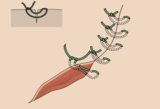 垂直褥式縫合水平褥式縫合subcuticular連續縫合連續縫合伸指肌腱縫合