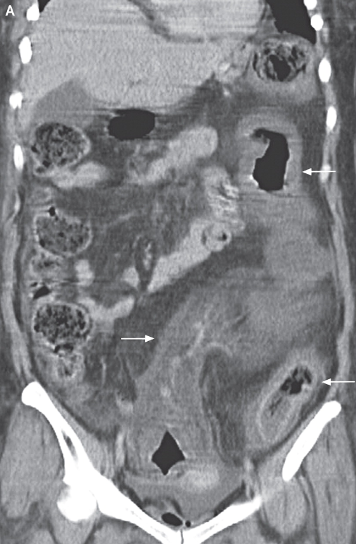 伪膜性肠炎临床病例与诊断