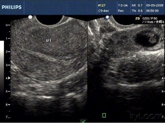 宫外孕B超图