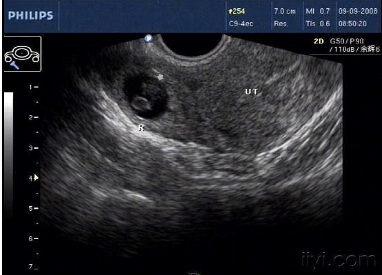 经典宫外孕B超图2