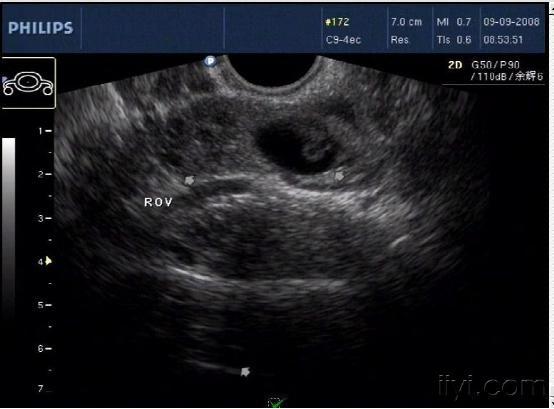 经典宫外孕B超图3
