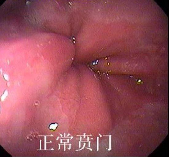 正常胃肠镜图片：贲门