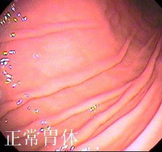 正常胃肠镜图片：正常胃体