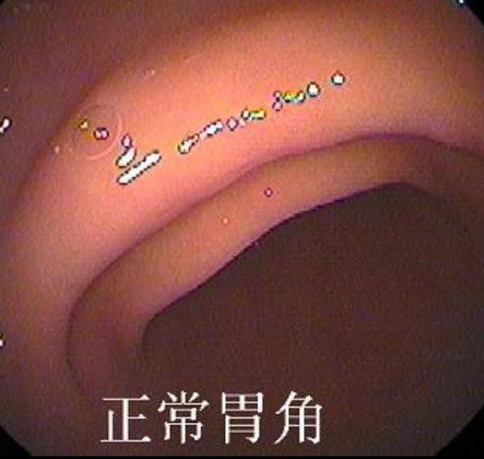 正常胃肠镜图片：正常胃角