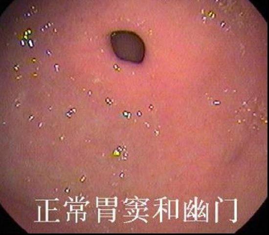 正常胃肠镜图片：正常胃窦和幽门