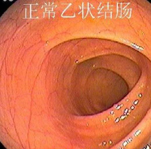 正常胃肠镜图片:正常乙状结肠