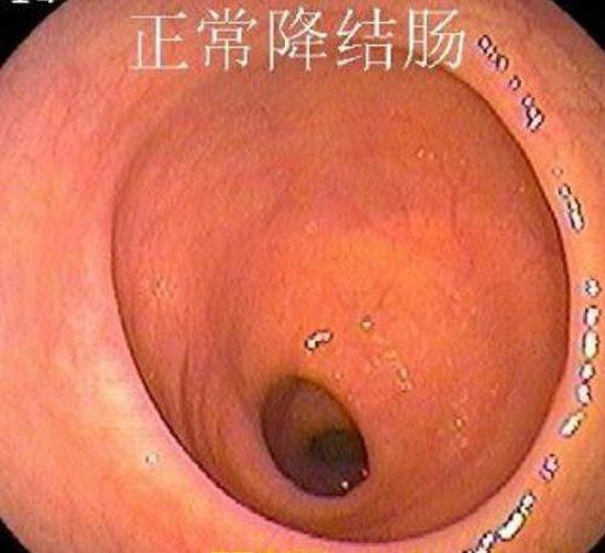 正常胃肠镜图片：正常降结肠